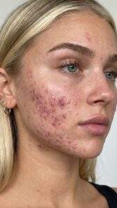 clear skin